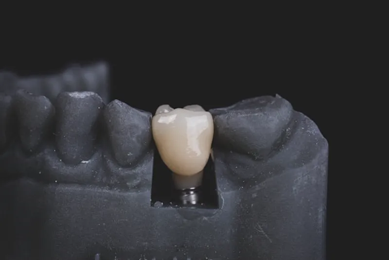 Implantes Dentários