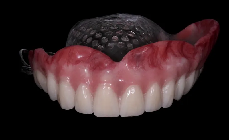 Prótese Dentária