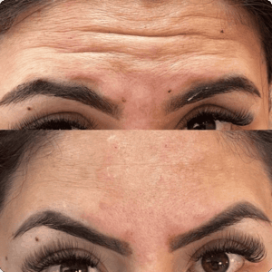 resultado paciente da dentista Alinne Carvalho especialista em reabilitação oral