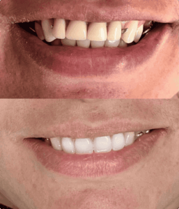 resultado paciente da dentista Alinne Carvalho especialista em reabilitação oral