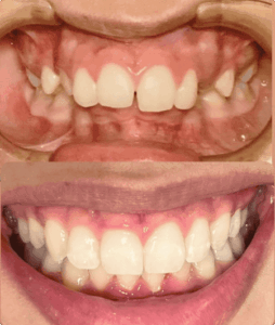 resultado paciente da dentista Alinne Carvalho especialista em reabilitação oral