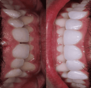 resultado paciente da dentista Alinne Carvalho especialista em reabilitação oral