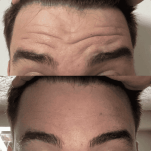 resultado paciente da dentista Alinne Carvalho especialista em reabilitação oral