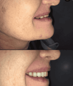 resultado paciente da dentista Alinne Carvalho especialista em reabilitação oral