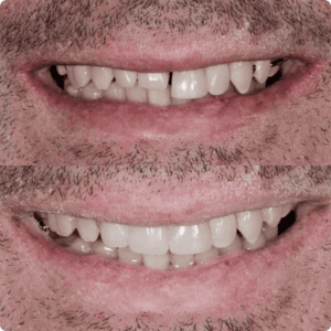 resultado paciente da dentista Alinne Carvalho especialista em reabilitação oral