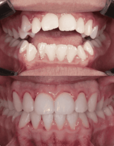 resultado paciente da dentista Alinne Carvalho especialista em reabilitação oral