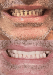 resultado paciente da dentista Alinne Carvalho especialista em reabilitação oral