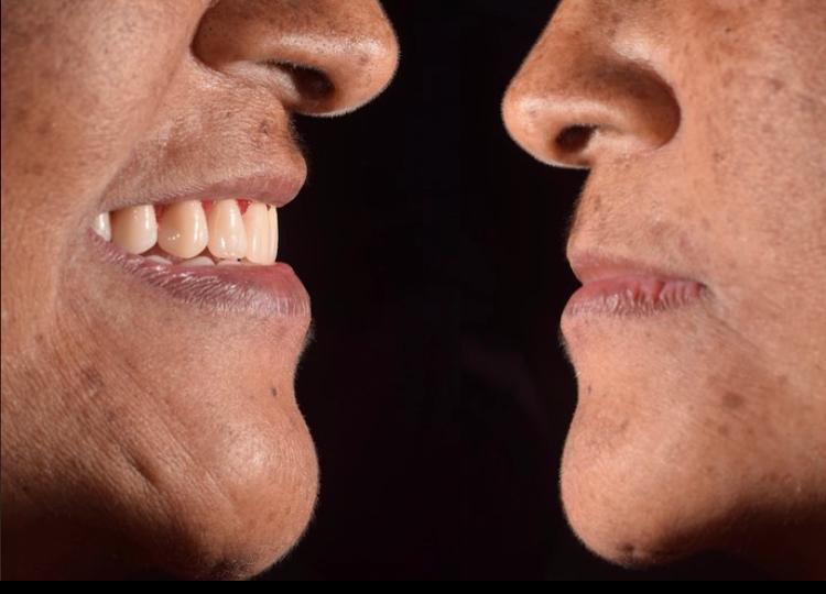 Depois de tratamento com reabilitação oral