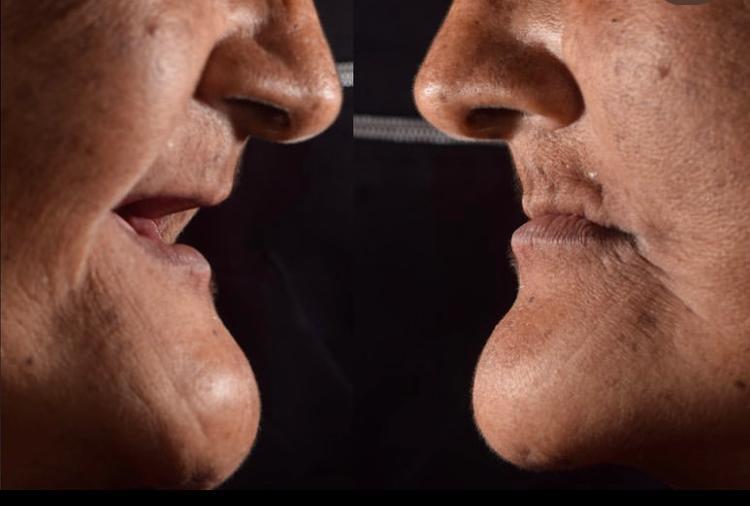 Antes de tratamento com reabilitação oral